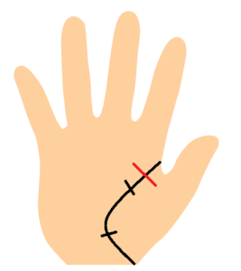 生命線の障害線の手相