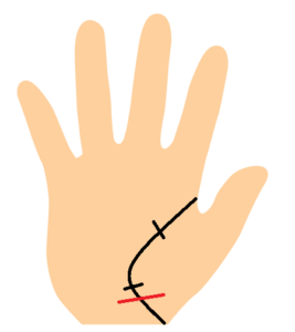 生命線に障害線がある手相