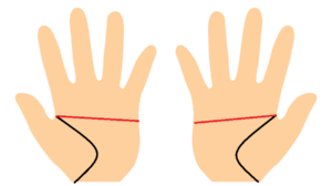 手相、両手マスカケ線