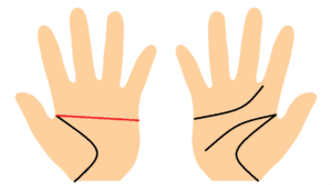 手相、左手だけがマスカケ線